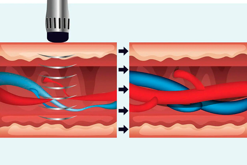 Formación sanitaria acreditada: Ondas de choque, la solución para heridas complejas